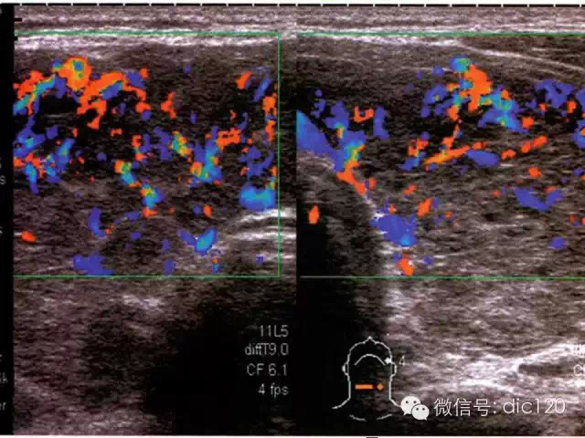 甲状腺常见疾病的影像表现与鉴别诊断