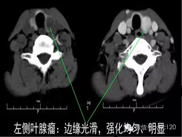 甲状腺常见疾病的影像表现与鉴别诊断