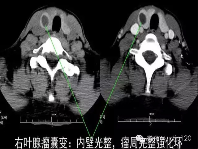 甲状腺常见疾病的影像表现与鉴别诊断