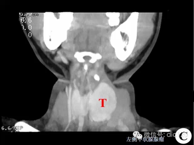 甲状腺常见疾病的影像表现与鉴别诊断