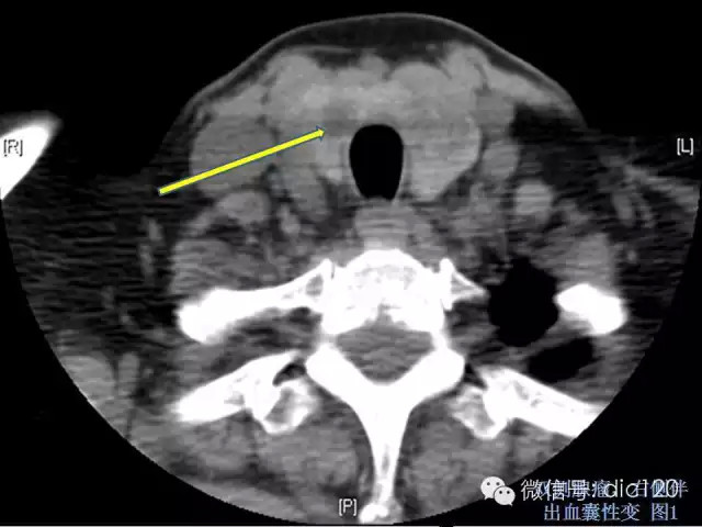 甲状腺常见疾病的影像表现与鉴别诊断