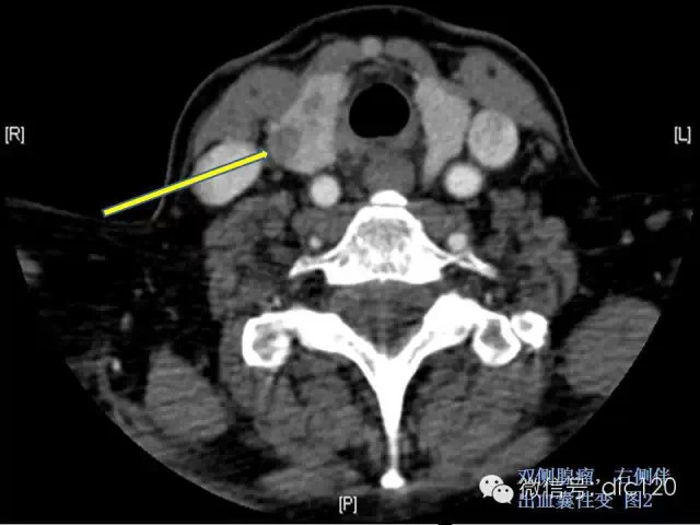 甲状腺常见疾病的影像表现与鉴别诊断