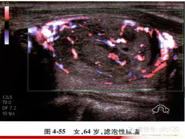 甲状腺常见疾病的影像表现与鉴别诊断