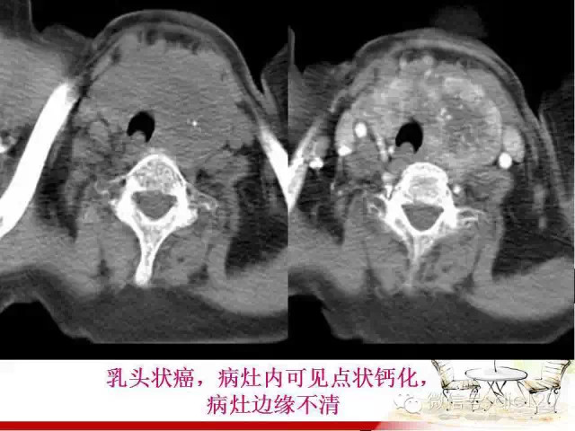 甲状腺常见疾病的影像表现与鉴别诊断