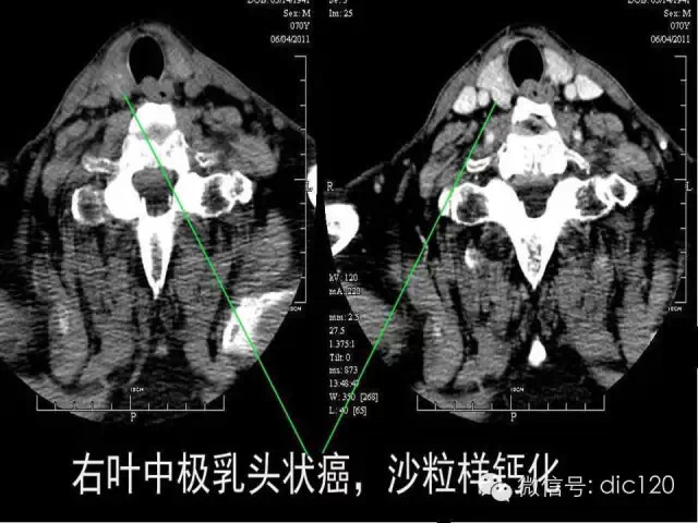 甲状腺常见疾病的影像表现与鉴别诊断