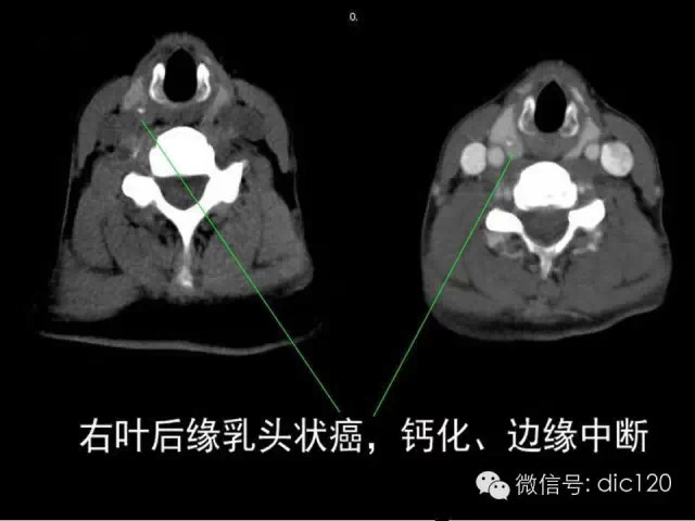甲状腺常见疾病的影像表现与鉴别诊断
