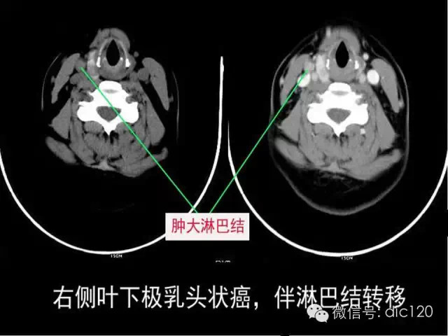 甲状腺常见疾病的影像表现与鉴别诊断