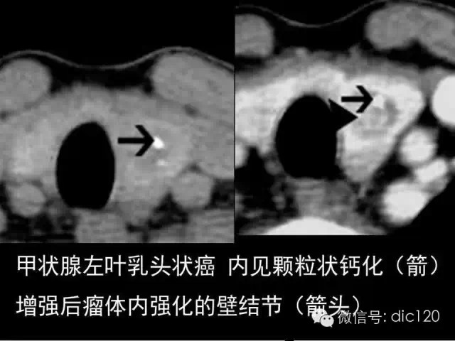 甲状腺常见疾病的影像表现与鉴别诊断