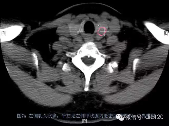 甲状腺常见疾病的影像表现与鉴别诊断