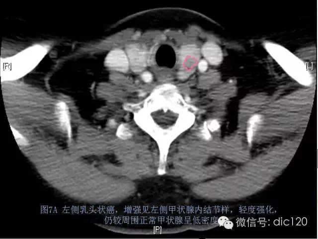 甲状腺常见疾病的影像表现与鉴别诊断