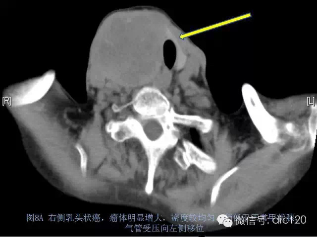 甲状腺常见疾病的影像表现与鉴别诊断