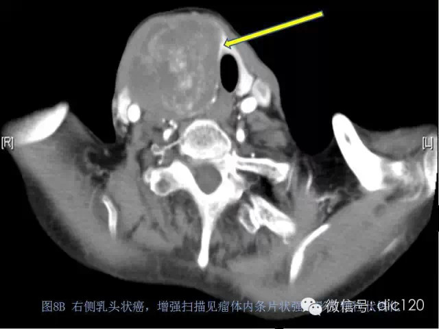 甲状腺常见疾病的影像表现与鉴别诊断