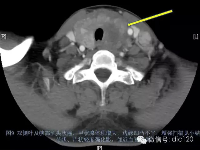 甲状腺常见疾病的影像表现与鉴别诊断