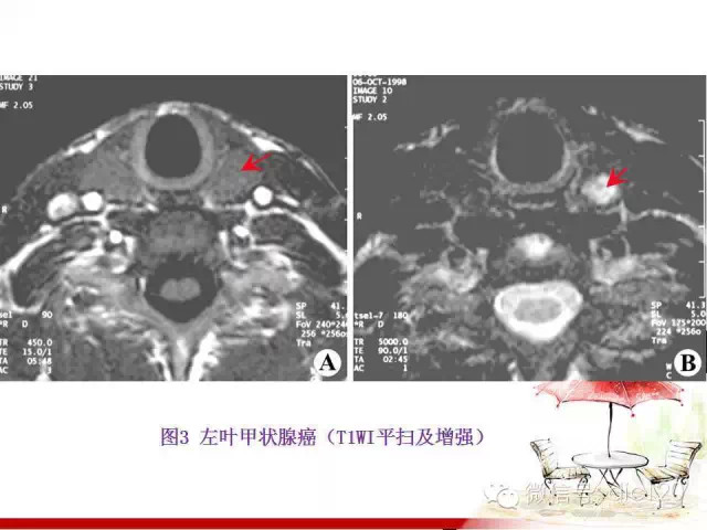 甲状腺常见疾病的影像表现与鉴别诊断