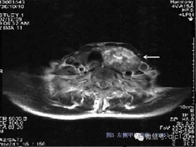 甲状腺常见疾病的影像表现与鉴别诊断