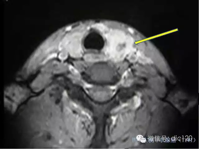 甲状腺常见疾病的影像表现与鉴别诊断