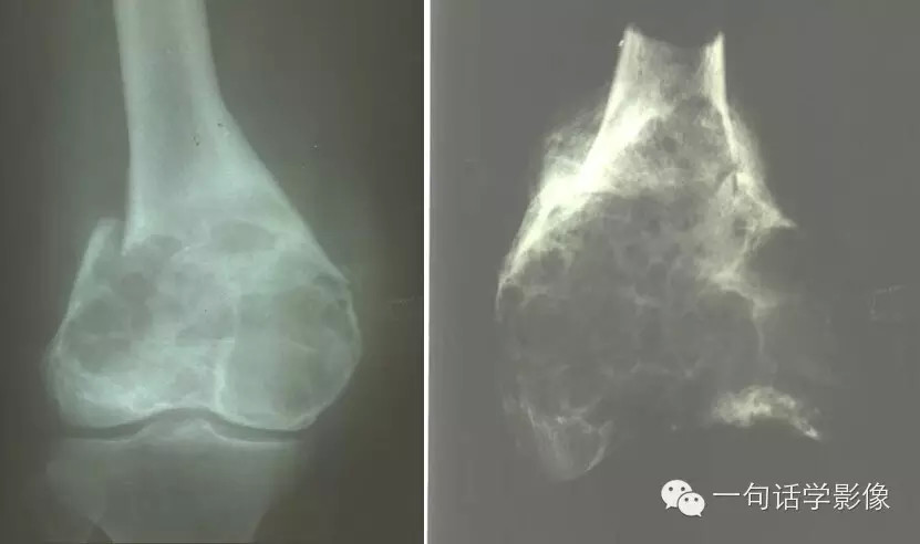 【一句话总结】骨巨细胞瘤内分隔原因及常见鉴别诊断 【一句话总结】骨巨细胞瘤内分隔原因及常见鉴别诊断