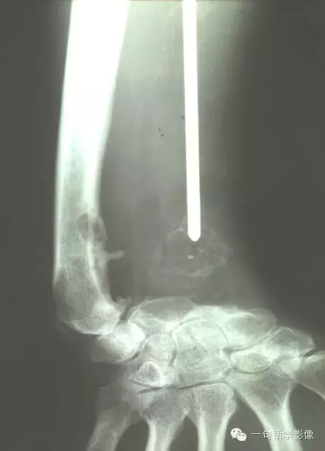 【一句话总结】骨巨细胞瘤内分隔原因及常见鉴别诊断 【一句话总结】骨巨细胞瘤内分隔原因及常见鉴别诊断