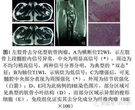 去分化型软骨肉瘤的CT、MRI表现3例