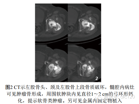 去分化型软骨肉瘤的CT、MRI表现3例 去分化型软骨肉瘤的CT、MRI表现3例