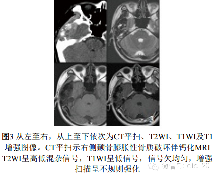 去分化型软骨肉瘤的CT、MRI表现3例 去分化型软骨肉瘤的CT、MRI表现3例