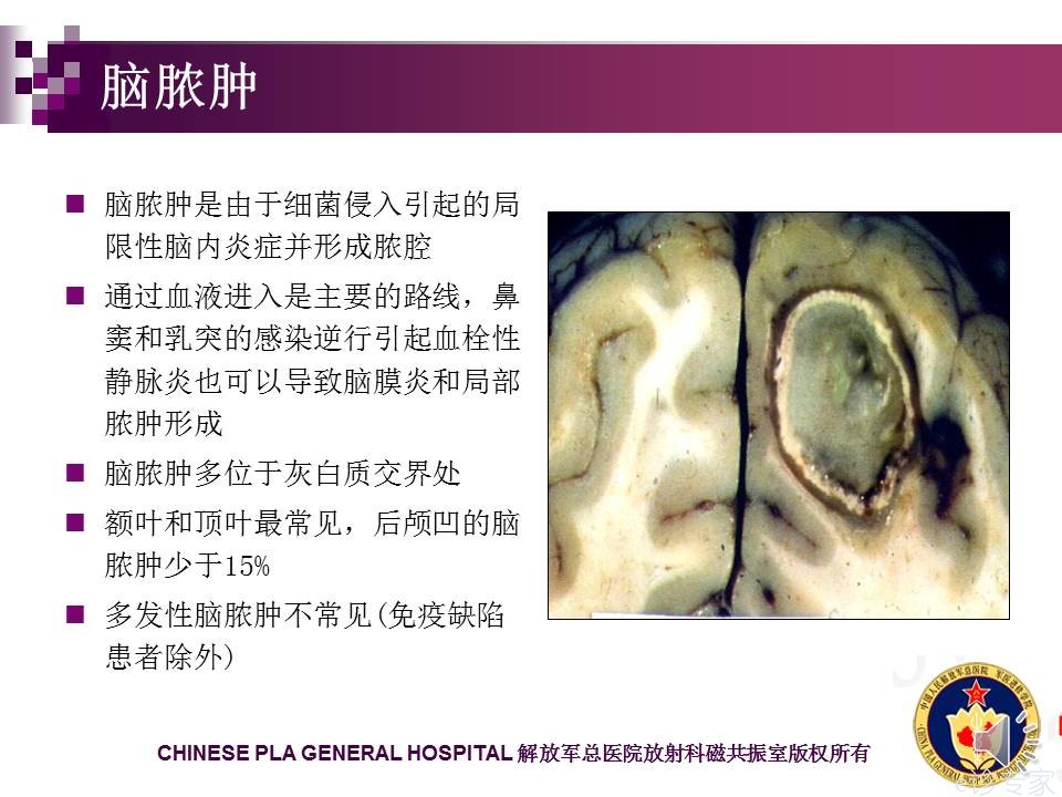 脑内环形强化病变：脑脓肿