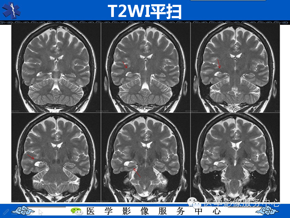 【病例学习】胚胎发育不良性神经上皮瘤一例影像诊断与鉴别