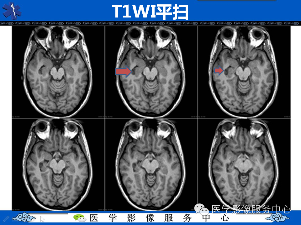 【病例学习】胚胎发育不良性神经上皮瘤一例影像诊断与鉴别