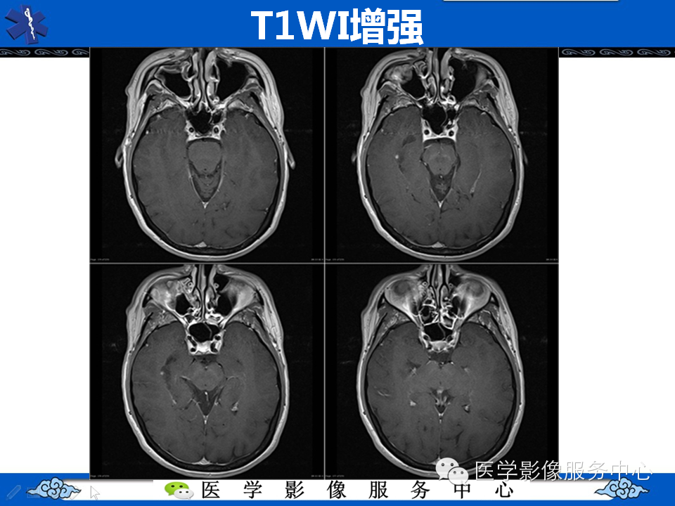 【病例学习】胚胎发育不良性神经上皮瘤一例影像诊断与鉴别