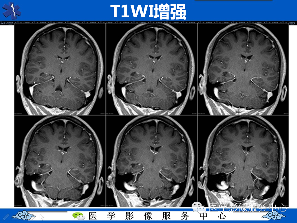 【病例学习】胚胎发育不良性神经上皮瘤一例影像诊断与鉴别