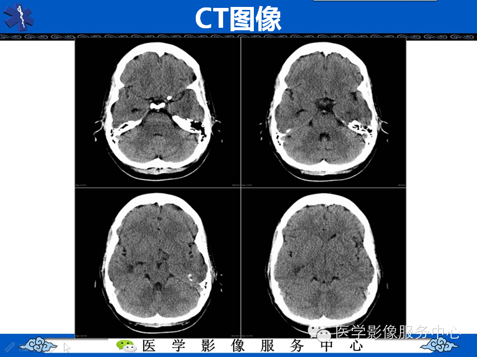 【病例学习】胚胎发育不良性神经上皮瘤一例影像诊断与鉴别