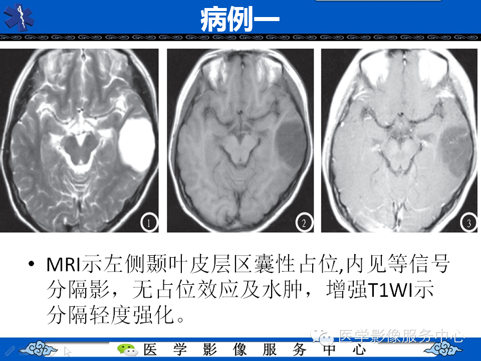 【病例学习】胚胎发育不良性神经上皮瘤一例影像诊断与鉴别