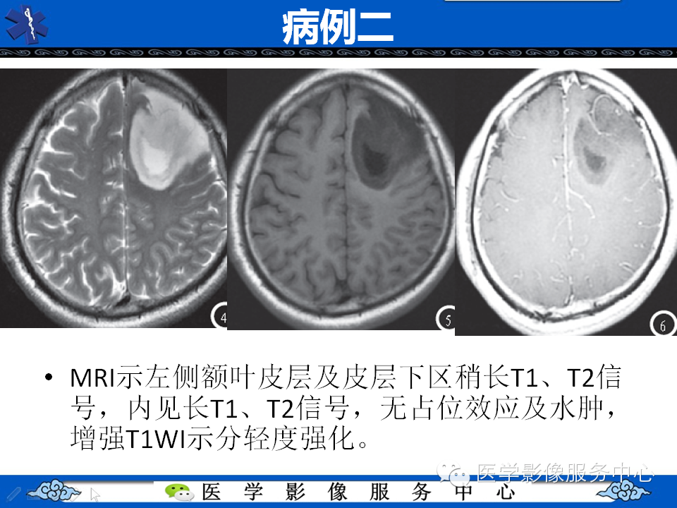 【病例学习】胚胎发育不良性神经上皮瘤一例影像诊断与鉴别