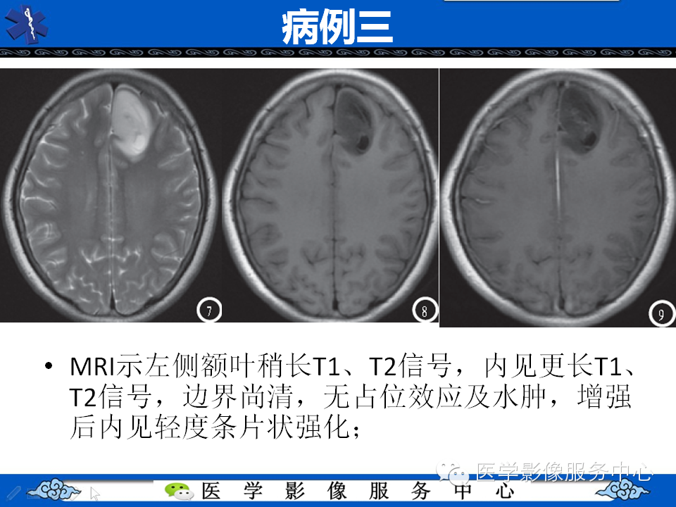 【病例学习】胚胎发育不良性神经上皮瘤一例影像诊断与鉴别