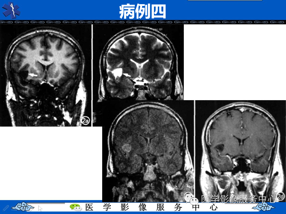 【病例学习】胚胎发育不良性神经上皮瘤一例影像诊断与鉴别