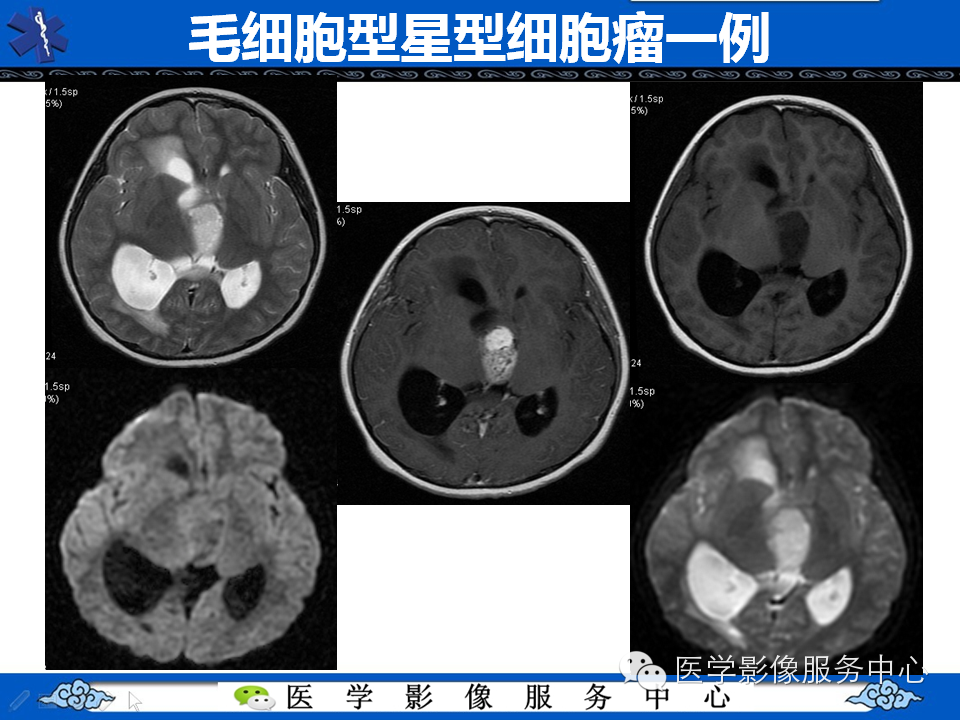【病例学习】胚胎发育不良性神经上皮瘤一例影像诊断与鉴别