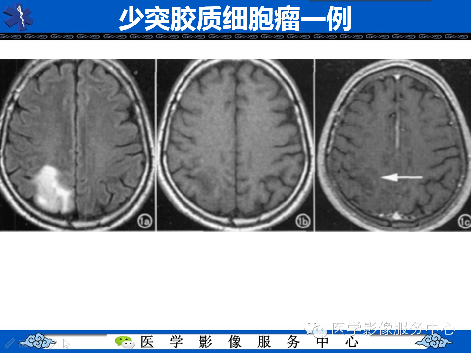 【病例学习】胚胎发育不良性神经上皮瘤一例影像诊断与鉴别