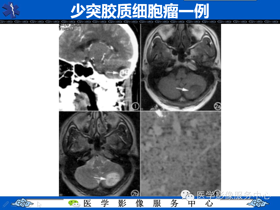 【病例学习】胚胎发育不良性神经上皮瘤一例影像诊断与鉴别