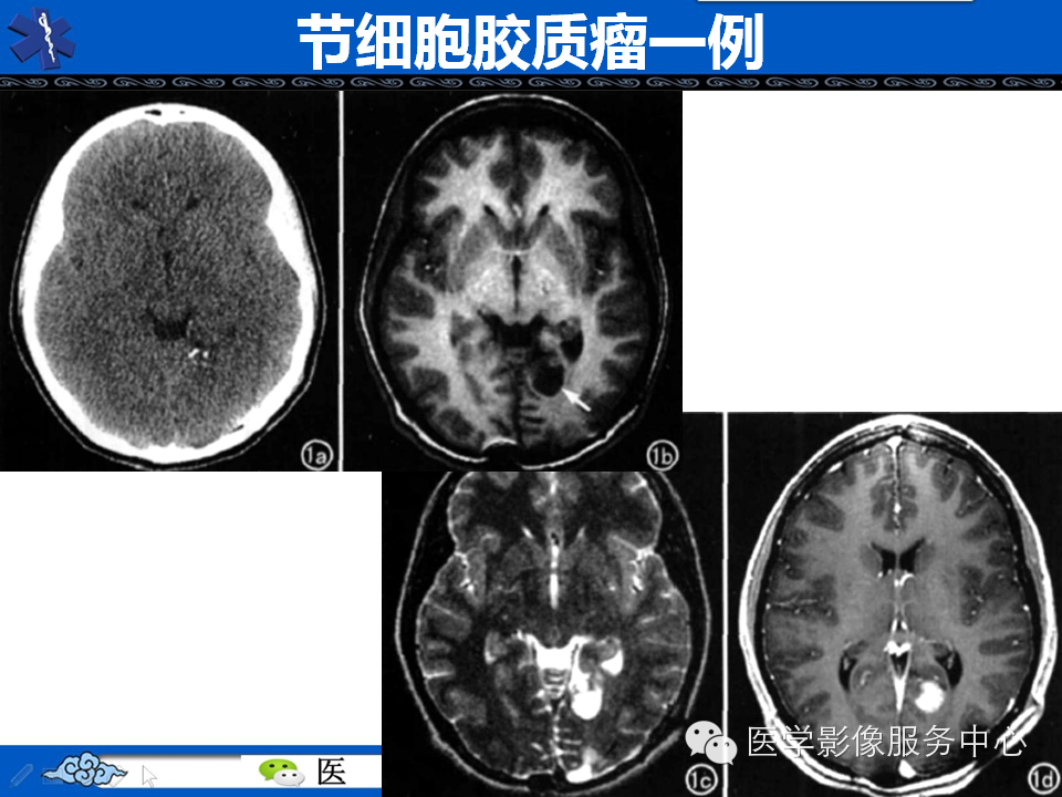 【病例学习】胚胎发育不良性神经上皮瘤一例影像诊断与鉴别