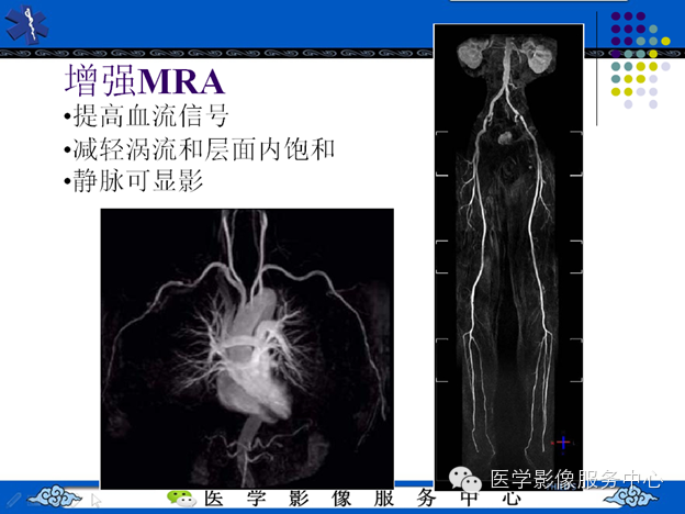 MRI血管造影