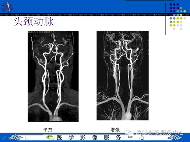 MRI血管造影