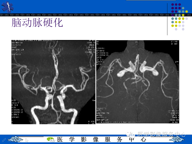 MRI血管造影