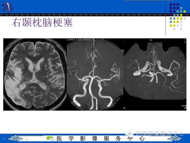 MRI血管造影