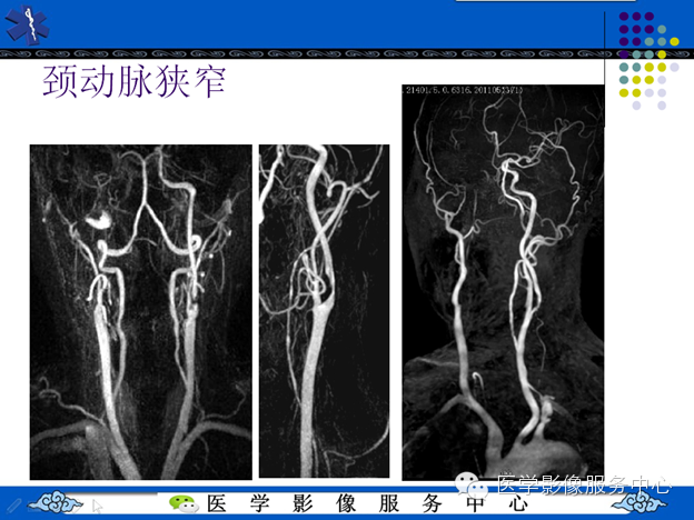 MRI血管造影