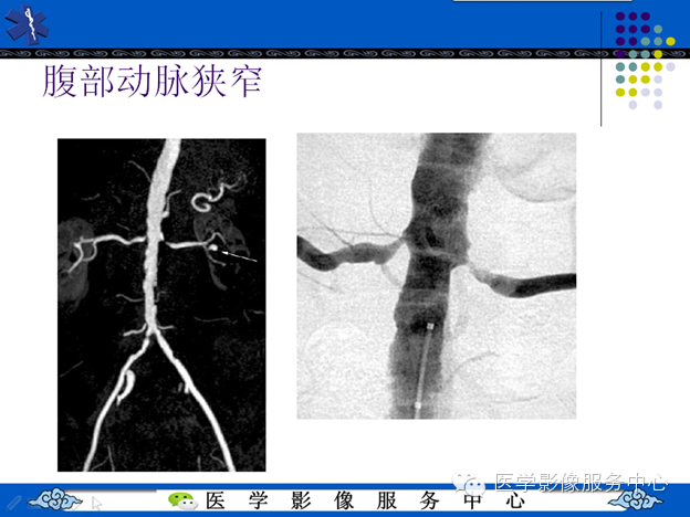 MRI血管造影
