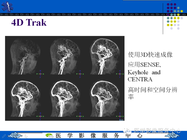 MRI血管造影