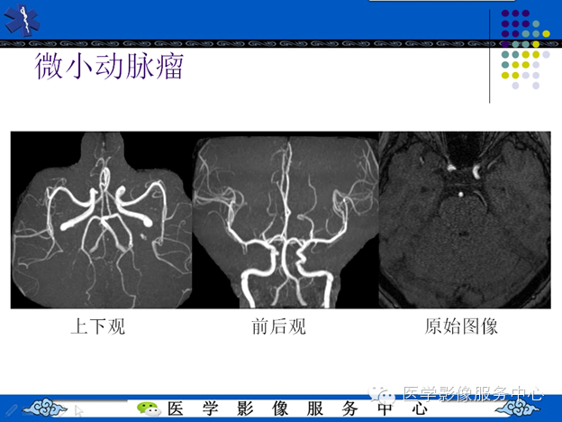 MRI血管造影