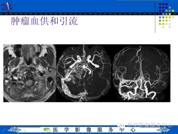 MRI血管造影