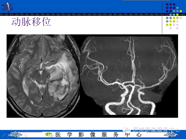 MRI血管造影