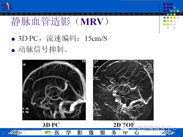 MRI血管造影